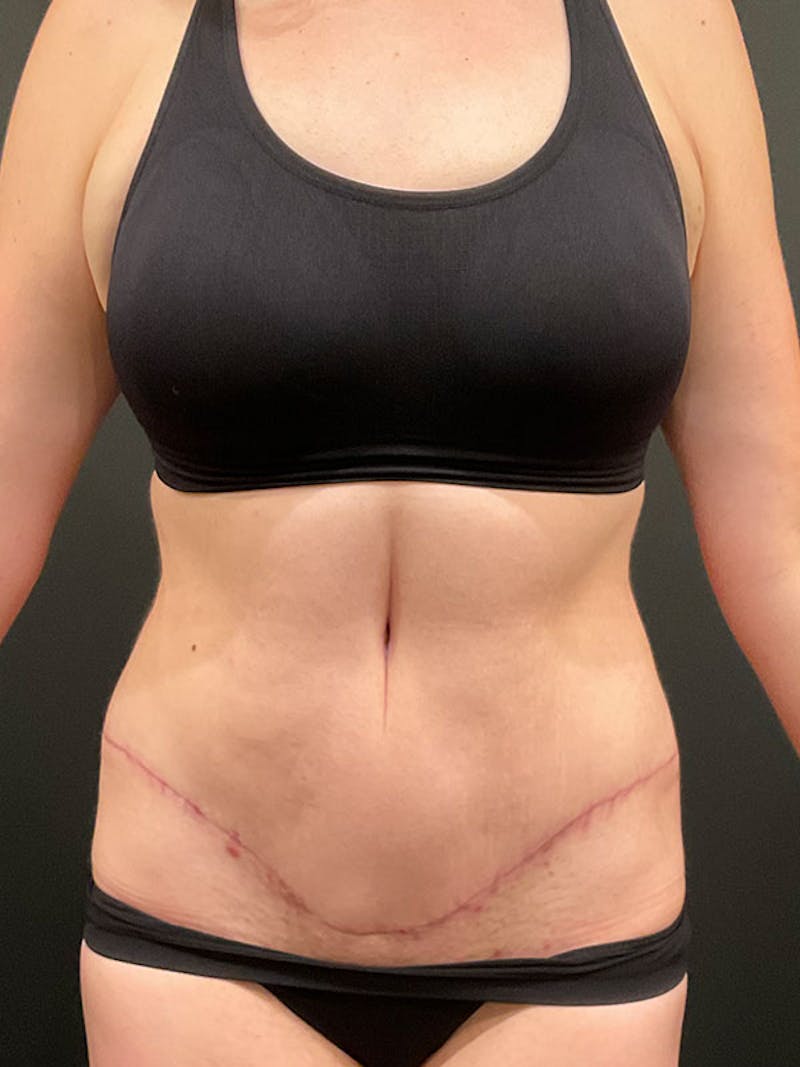 Tummy Tuck Before & After Gallery - Patient 332222 - Image 2