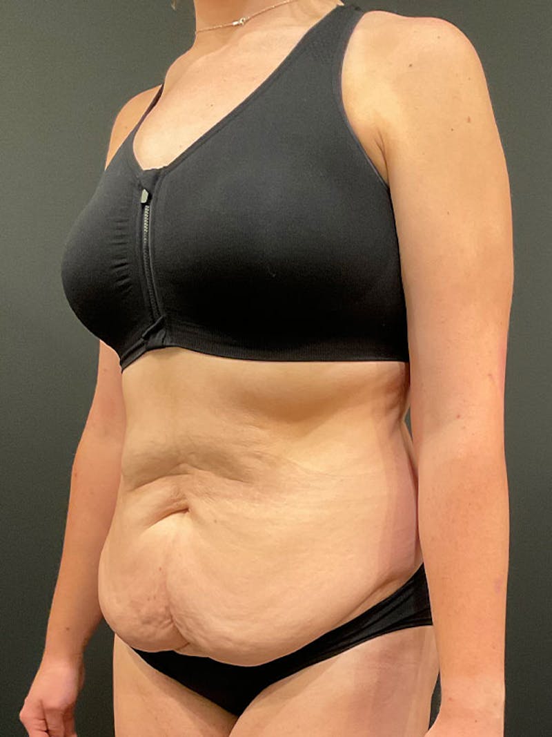 Tummy Tuck Before & After Gallery - Patient 332222 - Image 3