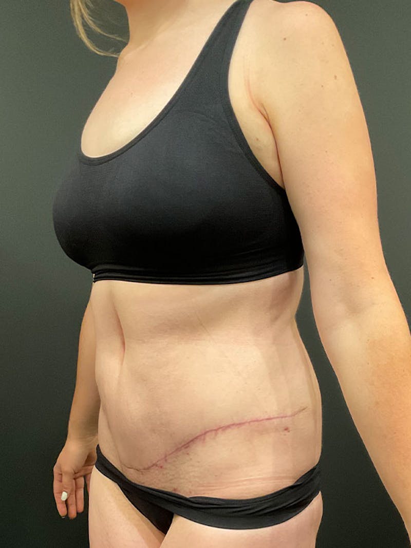 Tummy Tuck Before & After Gallery - Patient 332222 - Image 4