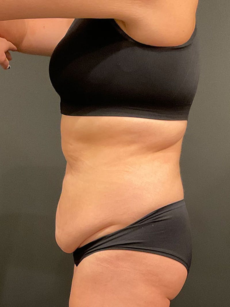 Tummy Tuck Before & After Gallery - Patient 332222 - Image 5