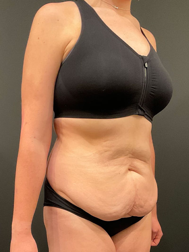 Tummy Tuck Before & After Gallery - Patient 332222 - Image 7