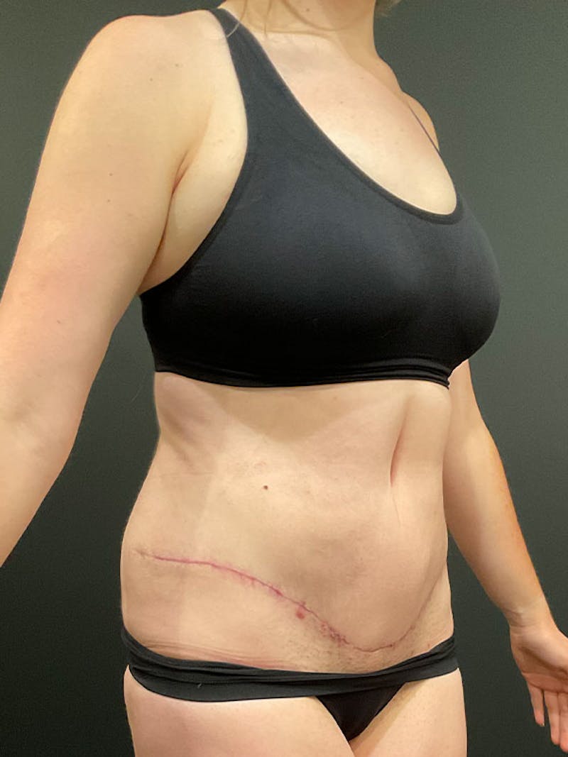 Tummy Tuck Before & After Gallery - Patient 332222 - Image 8