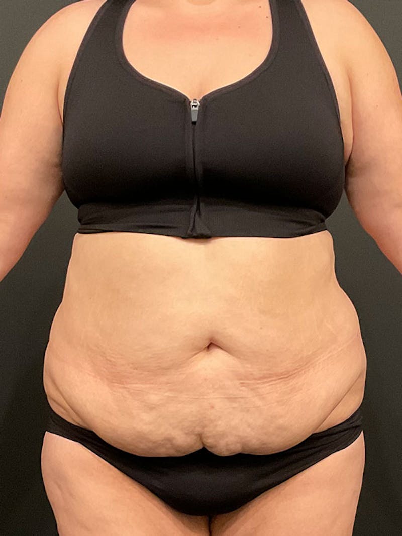 Tummy Tuck Before & After Gallery - Patient 409057 - Image 1