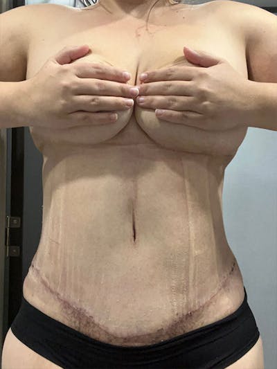 Tummy Tuck Before & After Gallery - Patient 409057 - Image 2