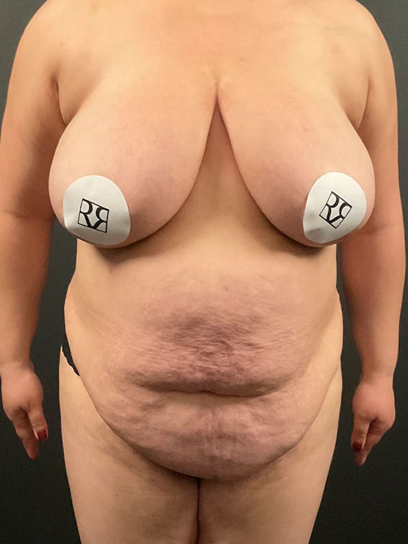 Tummy Tuck Before & After Gallery - Patient 137061 - Image 1