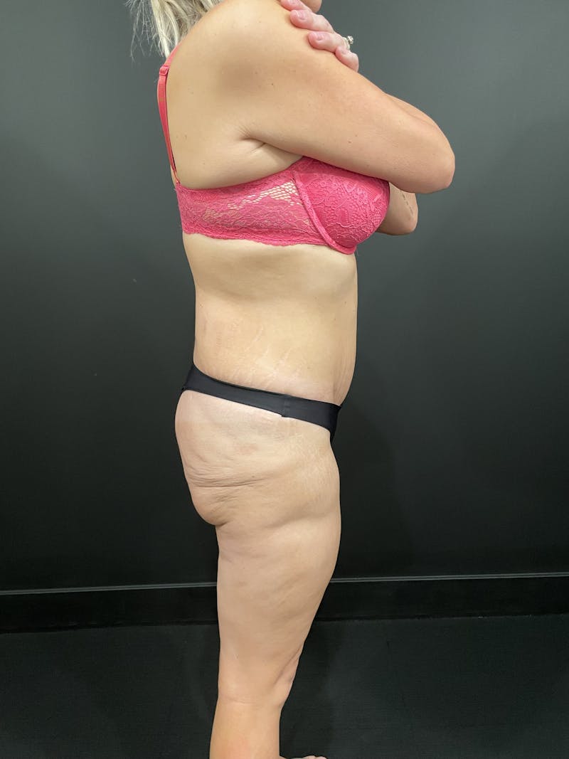 Buttock Shaping Before & After Gallery - Patient 413379 - Image 3