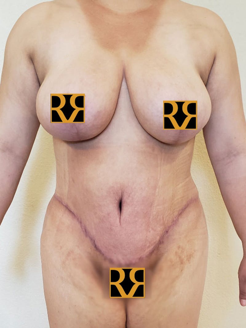 Tummy Tuck Before & After Gallery - Patient 137061 - Image 2