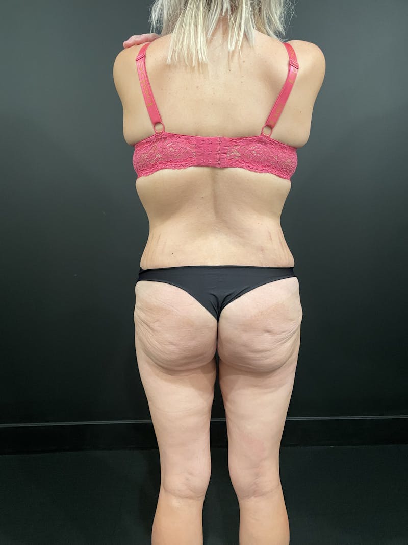 Brazilian Butt Lift Before & After Gallery - Patient 427160 - Image 5