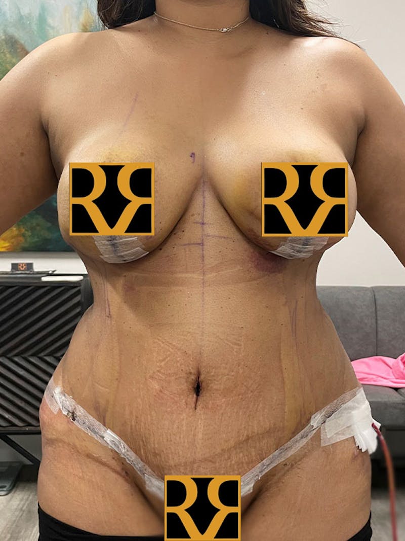 Tummy Tuck Before & After Gallery - Patient 281445 - Image 2