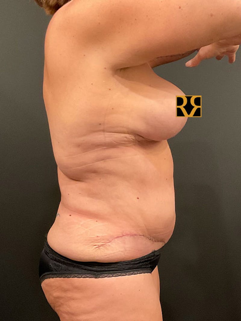 Tummy Tuck Before & After Gallery - Patient 122853 - Image 6