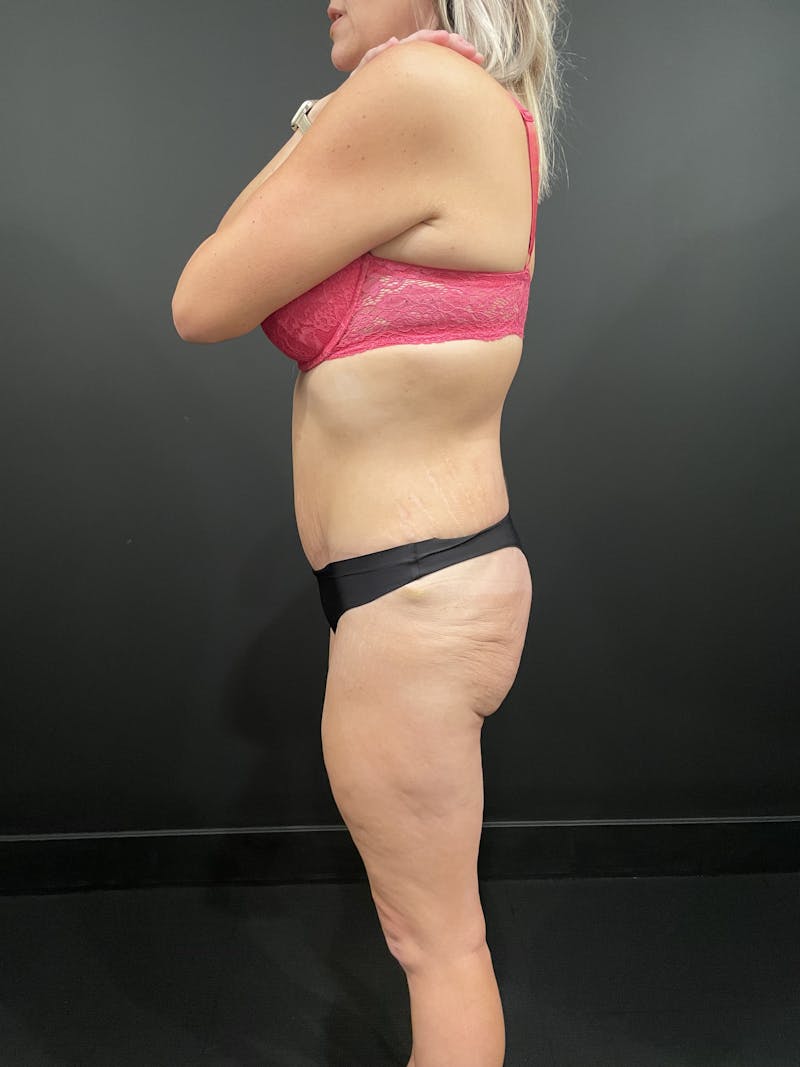 Buttock Shaping Before & After Gallery - Patient 413379 - Image 9