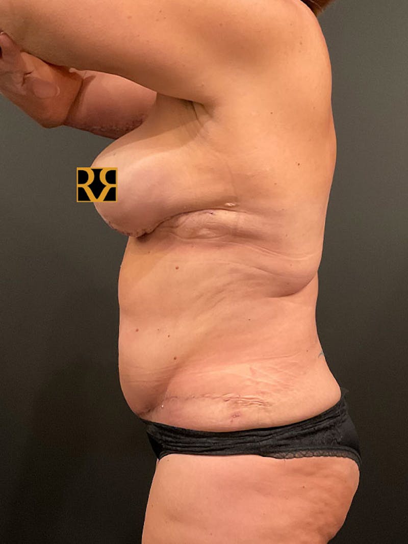Tummy Tuck Before & After Gallery - Patient 122853 - Image 8
