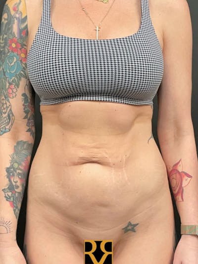 Tummy Tuck Before & After Gallery - Patient 398663 - Image 1
