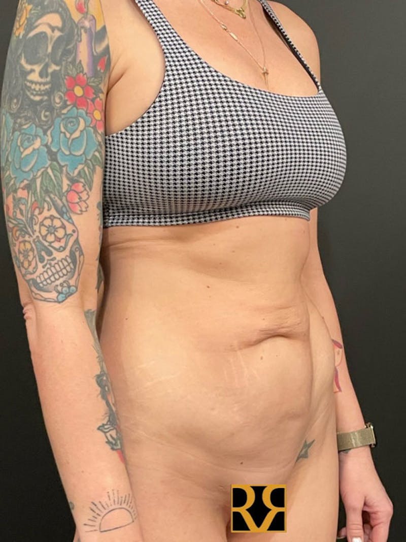 Tummy Tuck Before & After Gallery - Patient 398663 - Image 3