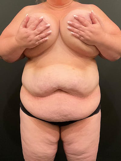 Plus Size Tummy Tuck ® Before & After Gallery - Patient 618131 - Image 1