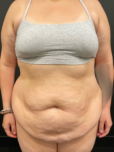 Tummy Tuck Before & After Gallery - Patient 595949 - Image 1