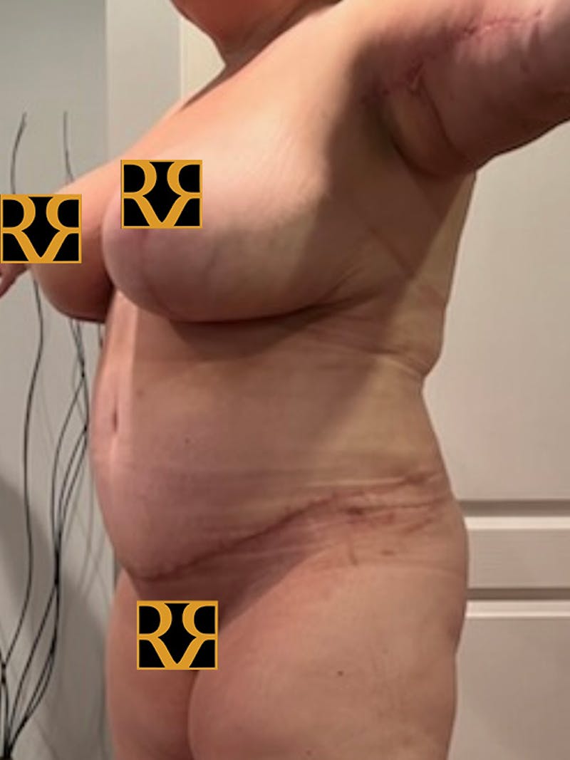 Plus Size Tummy Tuck ® Before & After Gallery - Patient 618131 - Image 6