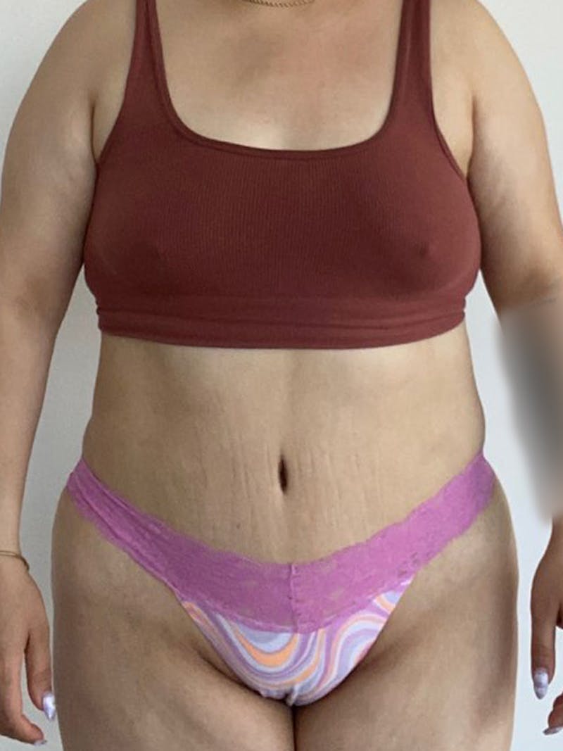 Tummy Tuck Before & After Gallery - Patient 595949 - Image 2