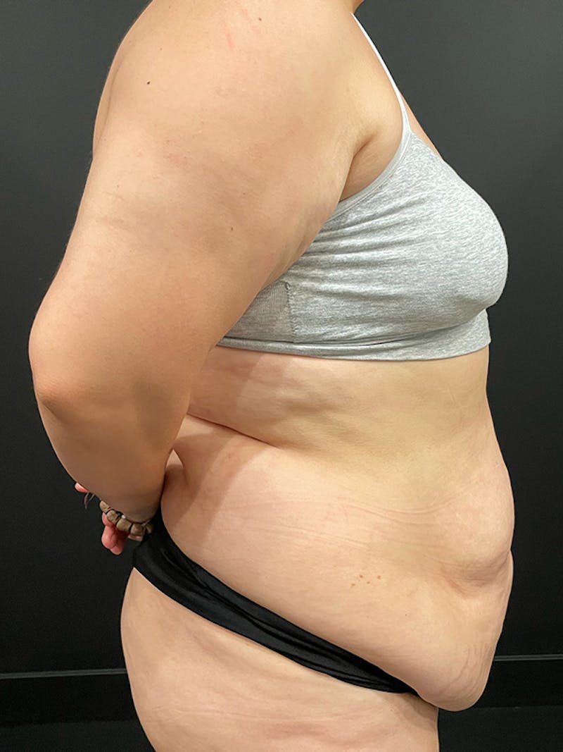 Tummy Tuck Before & After Gallery - Patient 595949 - Image 3