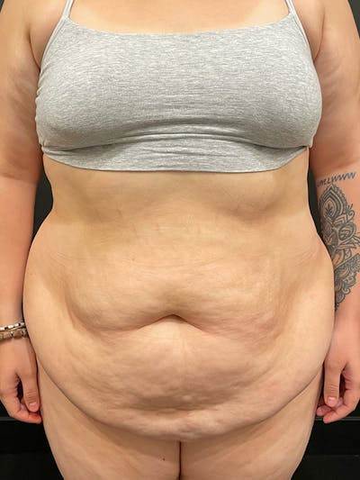 Plus Size Tummy Tuck ® Before & After Gallery - Patient 224315 - Image 1