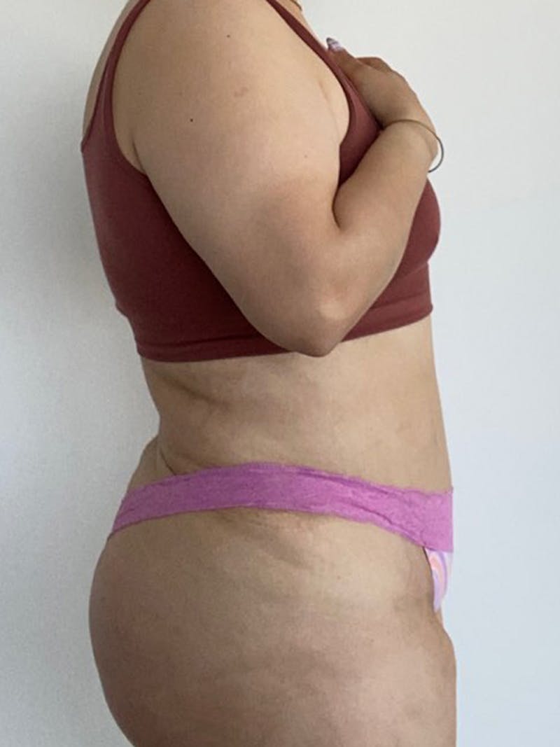 Tummy Tuck Before & After Gallery - Patient 595949 - Image 4