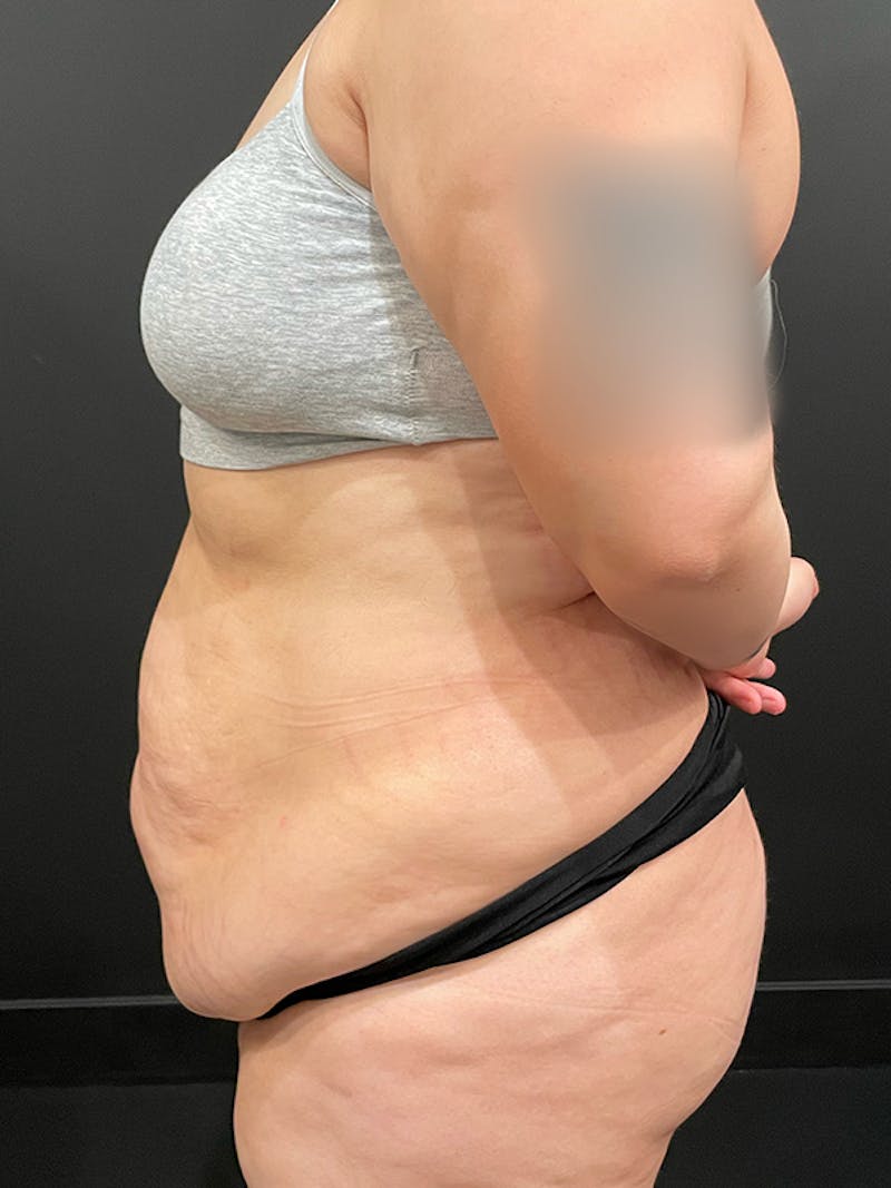 Tummy Tuck Before & After Gallery - Patient 595949 - Image 5