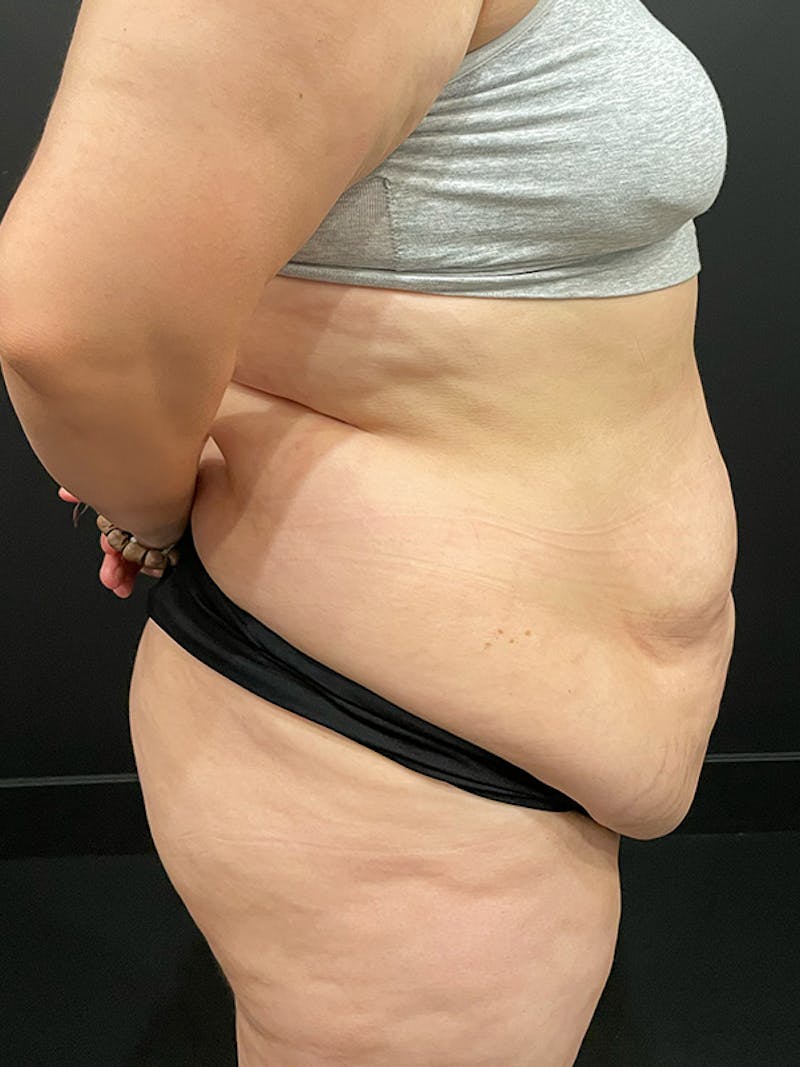 Plus Size Tummy Tuck ® Before & After Gallery - Patient 224315 - Image 3