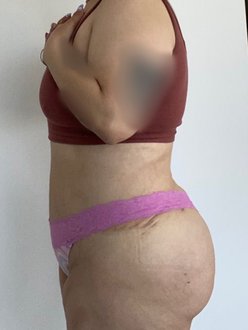 Tummy Tuck Before & After Gallery - Patient 595949 - Image 6