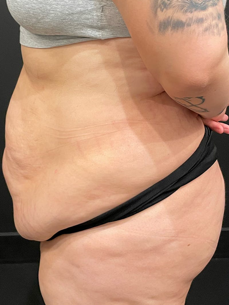 Plus Size Tummy Tuck ® Before & After Gallery - Patient 224315 - Image 5