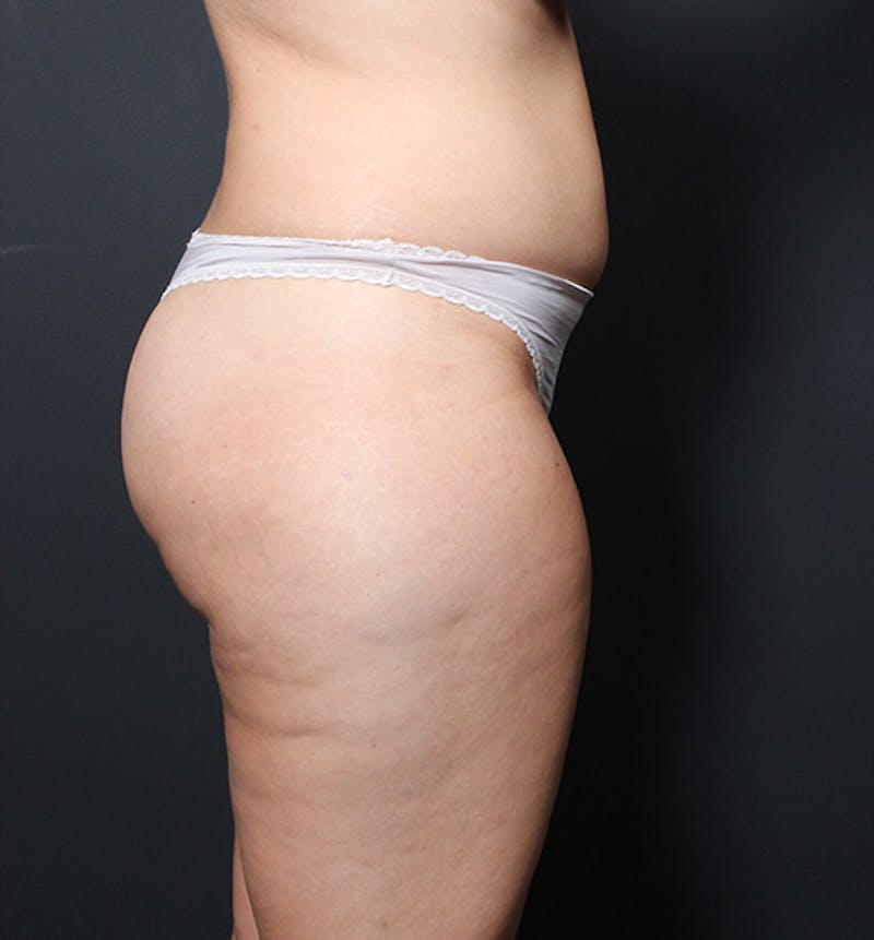Brazilian Butt Lift Before & After Gallery - Patient 209830 - Image 5