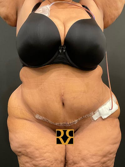 Plus Size Tummy Tuck: Week After Surgery Before & After Gallery - Patient 409675 - Image 2