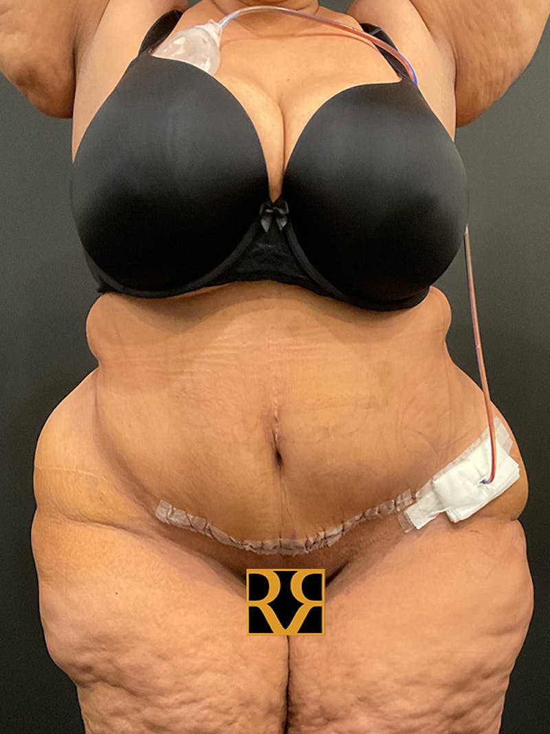 Plus Size Tummy Tuck ® Before & After Gallery - Patient 421920 - Image 2