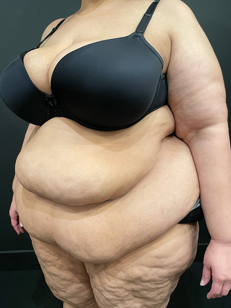 Plus Size Tummy Tuck: Week After Surgery Before & After Gallery - Patient 409675 - Image 3