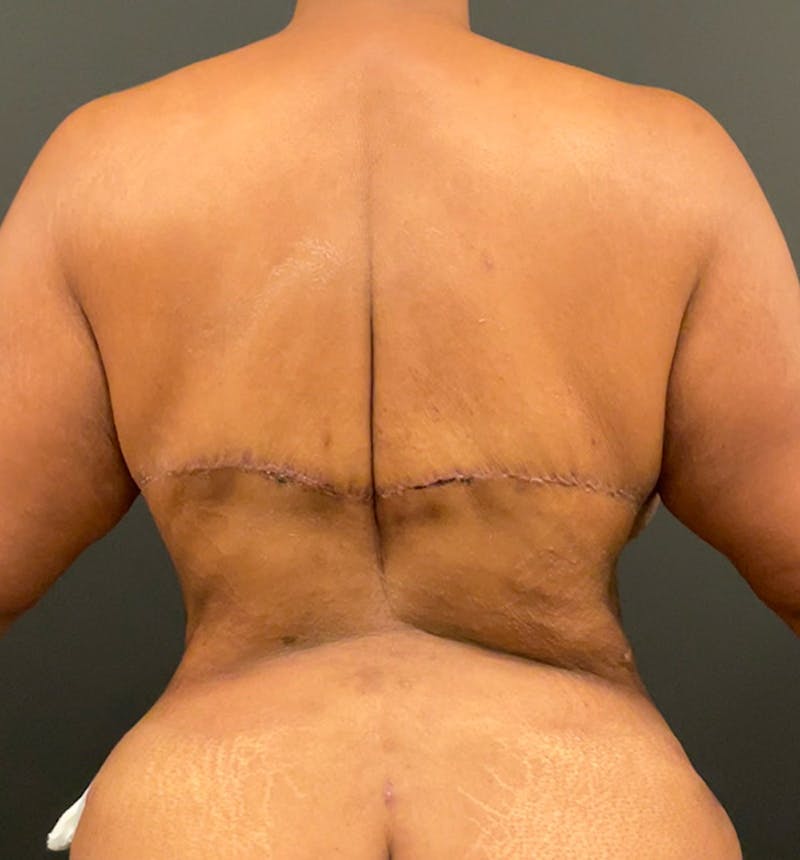 Bra Line Back Lift ™ Before & After Gallery - Patient 874373 - Image 2
