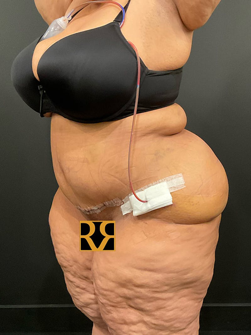 Plus Size Tummy Tuck: Week After Surgery Before & After Gallery - Patient 409675 - Image 4