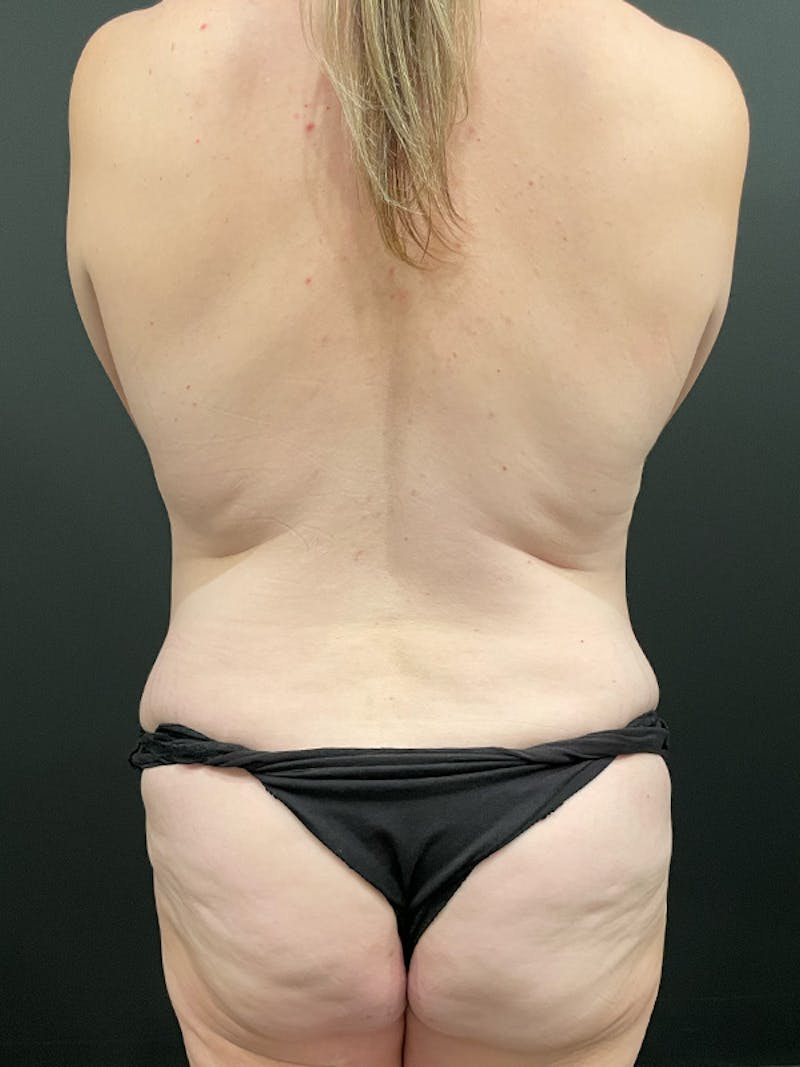 Tummy Tuck Before & After Gallery - Patient 105266 - Image 7