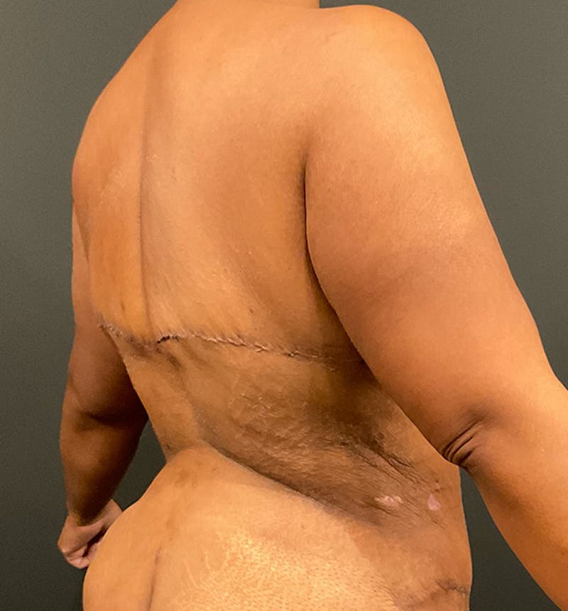 Bra Line Back Lift ™ Before & After Gallery - Patient 874373 - Image 4