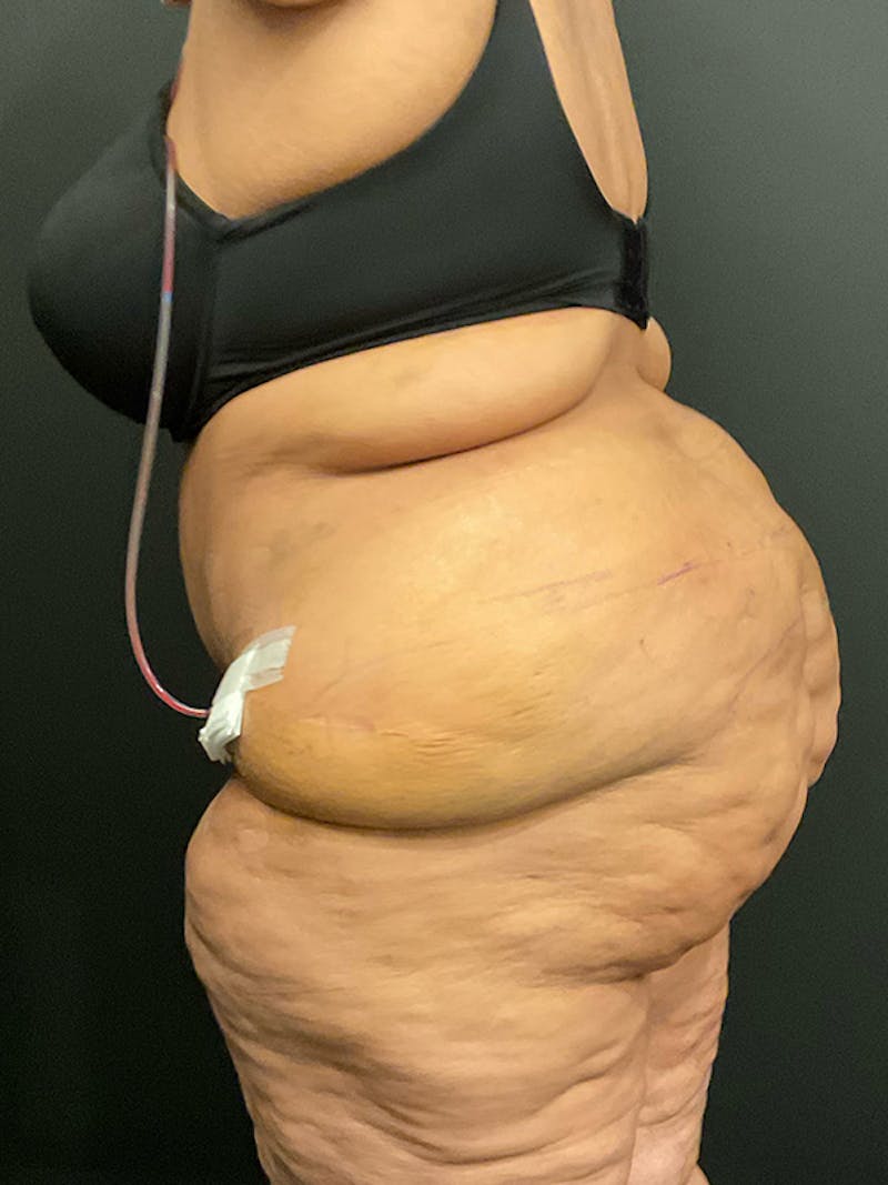 Plus Size Tummy Tuck: Week After Surgery Before & After Gallery - Patient 409675 - Image 6