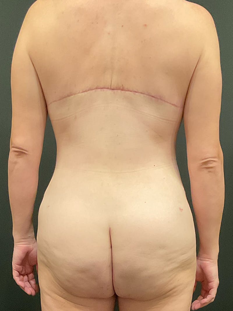 Tummy Tuck Before & After Gallery - Patient 105266 - Image 8