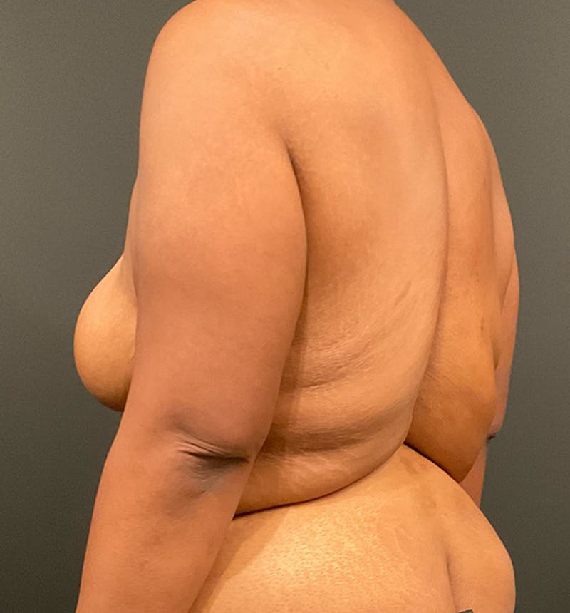 Bra Line Back Lift ™ Before & After Gallery - Patient 874373 - Image 5