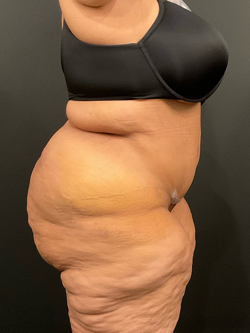 Plus Size Tummy Tuck: Week After Surgery Before & After Gallery - Patient 409675 - Image 8
