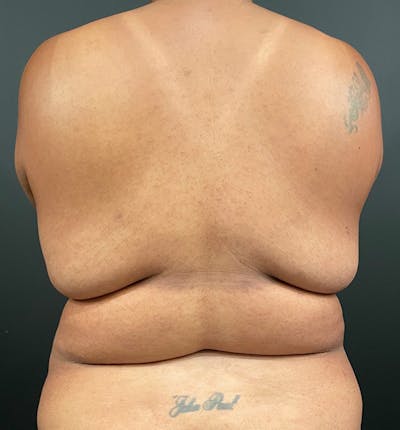 Bra Line Back Lift ™ Before & After Gallery - Patient 229555 - Image 1