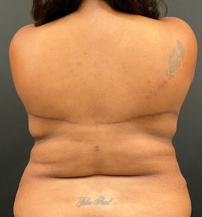 Bra Line Back Lift ™ Before & After Gallery - Patient 229555 - Image 2
