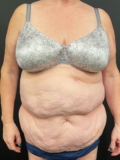Tummy Tuck Before & After Gallery - Patient 191986 - Image 1