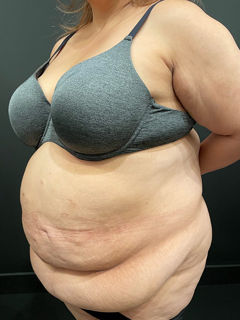 Plus Size Tummy Tuck ® Before & After Gallery - Patient 969627 - Image 3