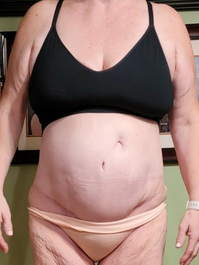 Tummy Tuck Before & After Gallery - Patient 191986 - Image 2