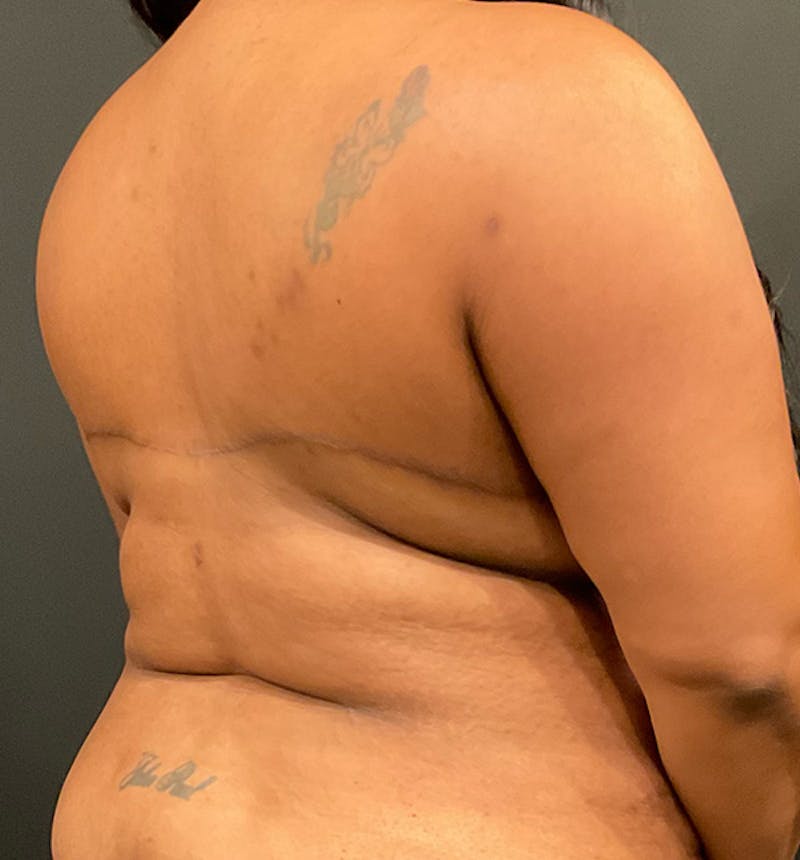 Bra Line Back Lift ™ Before & After Gallery - Patient 229555 - Image 6