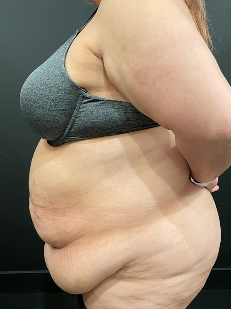 Plus Size Tummy Tuck ® Before & After Gallery - Patient 969627 - Image 5