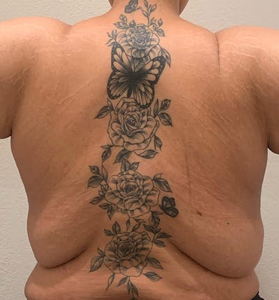 Bra Line Back Lift ™ Before & After Gallery - Patient 348485 - Image 1