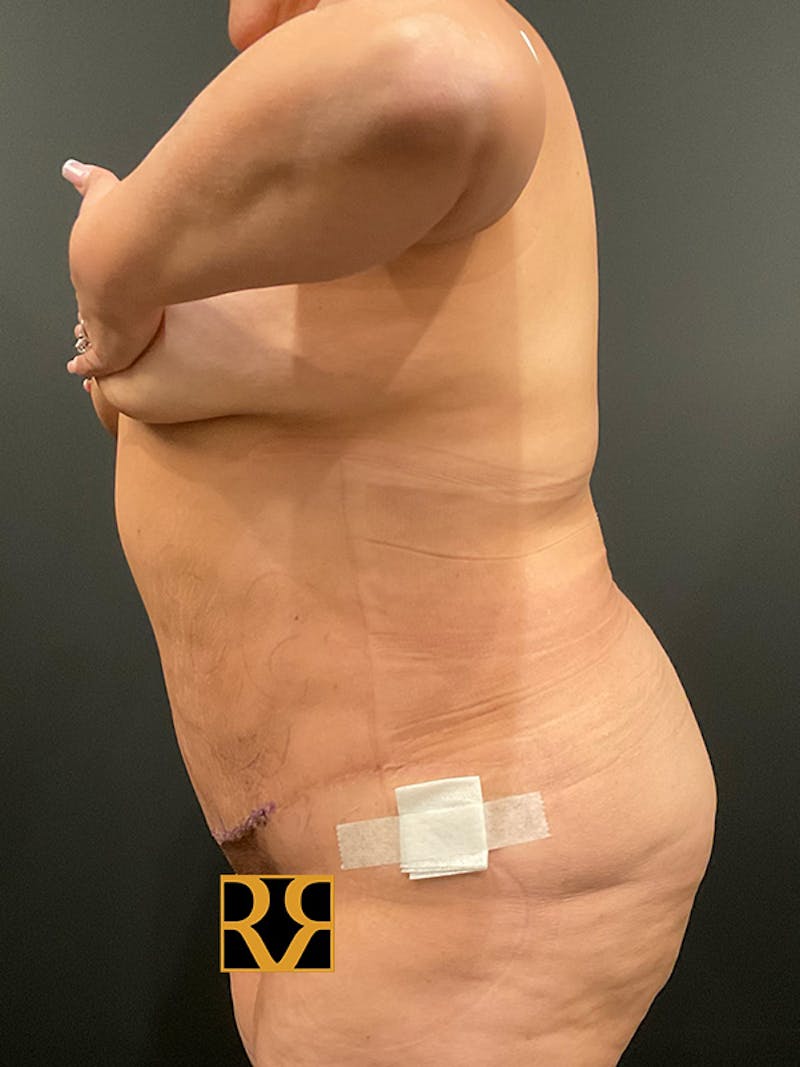Plus Size Tummy Tuck ® Before & After Gallery - Patient 969627 - Image 6